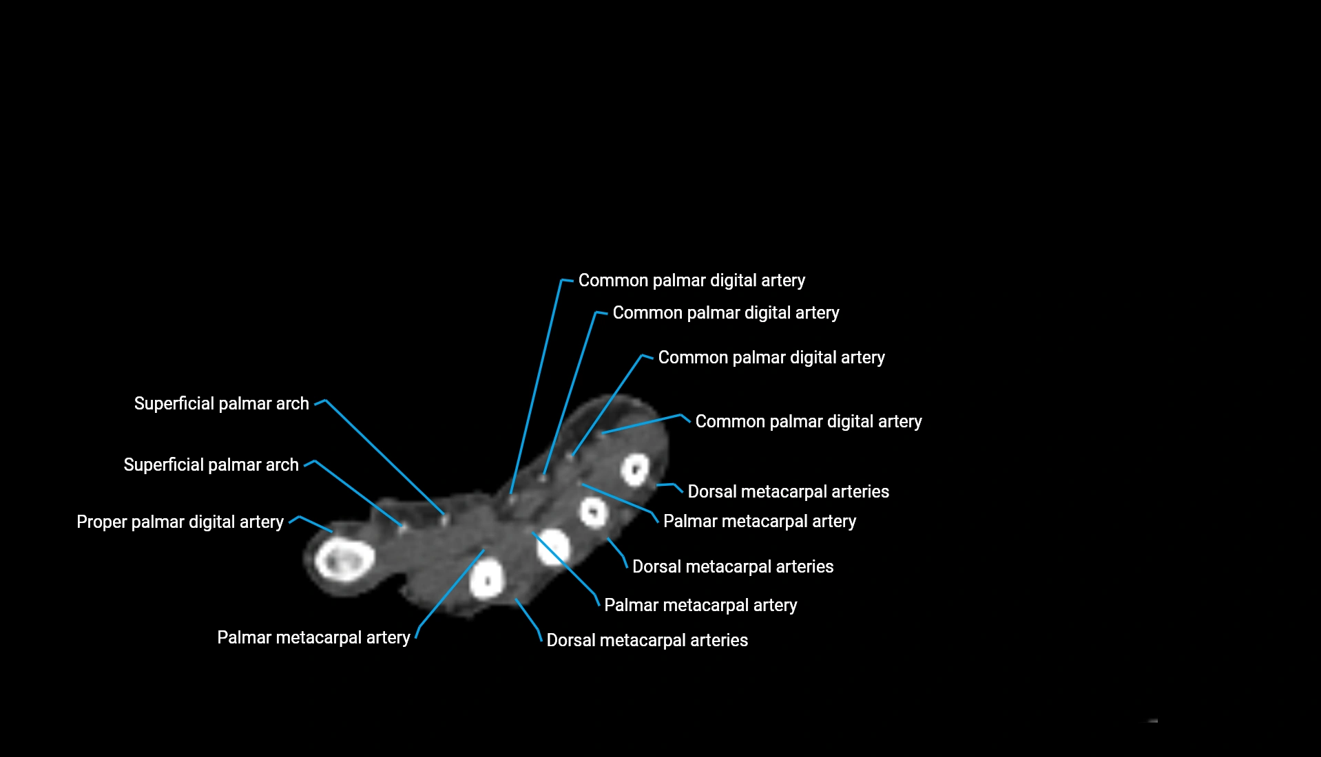 CTA upper limb axial cross sectional anatomy labelled image 57 (2).webp